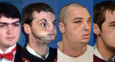 Najuspješnije presađivanje lica u povijesti