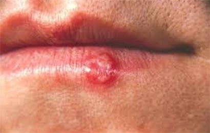 herpes