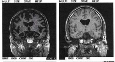  Za rano otkrivanje Alzheimera