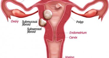 Vaginalne gljivične infekcije i probiotici