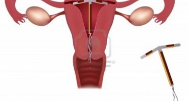 Kontracepcija: Unutarmaternična sredstva (spirale)