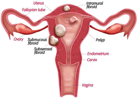 Fibroidi (miom maternice) 