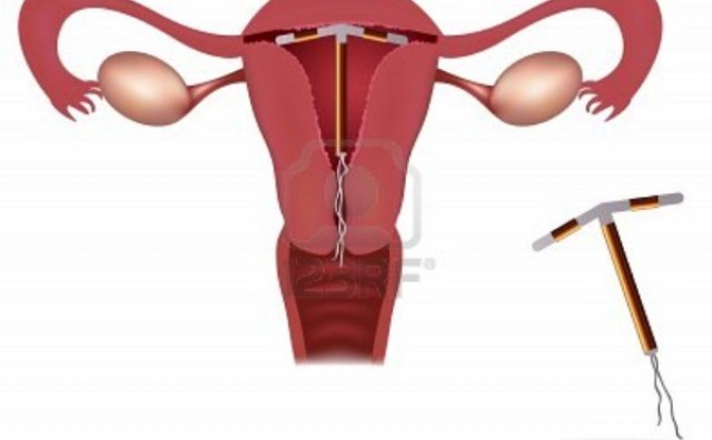 Kontracepcija: Unutarmaternična sredstva (spirale)