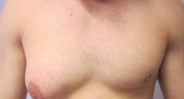 dojka, farshad hashemzsdeh, narasla dojka