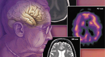 Čak 44 milijuna ljudi u svijetu pati od demencije