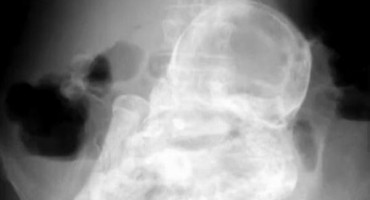 fetus, 40 godina, u stomaku