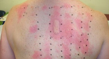 Djecu alergičnu na kikiriki lijeće kikirikijem