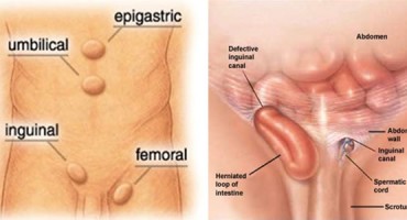 Bruh (lat: Hernia), Simptomi preponske kile, poseban slučaj hernije, uklještenje tkiva, Hijatus hernija, podrigivanje, žgravica