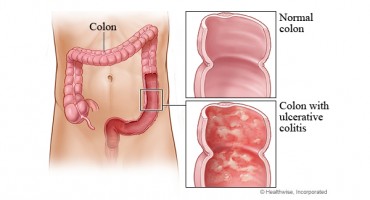 Upala debelog crijeva – prirodno liječenje