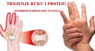 karpalni ligament, karpalni kanal, Medijanus, Sindom karpalnog kanala, Utrnutost, trnci, osjećaj žarenja, simptomi, bolovi u podlaktici