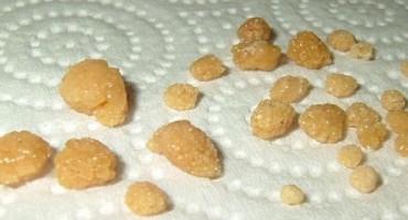 Zbog čega nastaju bubrežni kamenci 