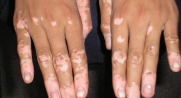  Senzacionalno: Osječka liječnica otkrila lijek za depigmentaciju kože 