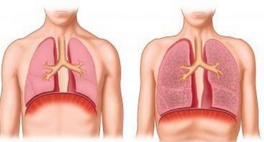 Tuberkoloza je još uvjek aktivna i opasna 