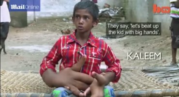 Vrlo rijedak poremećaj: Dječak ima ogromne ruke teške po osam kilograma