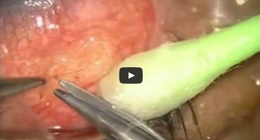 U oku pronašli crva!