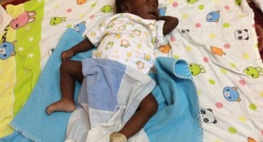 parazitski blizanac, bolnica, operacija