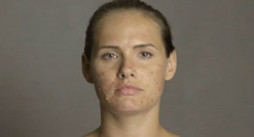 Kako bi razumjela kako je ljudima s aknama napravila je ovo!