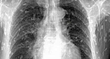 trakavice, jelo, zaraza