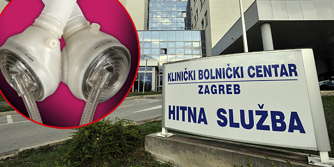 Hrvatski liječnici ugradili prvo umjetno srce
