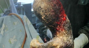 Bizarna ovisnost - ne biste vjerovali što su joj odstranili iz želuca!