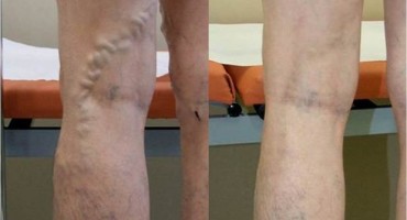 Riješio težak zdravstveni problem na lak i prirodan način!