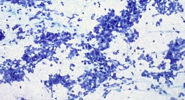 Kuba ima cjepivo protiv karcinoma pluća (i Amerika ga, čini se, jako želi)