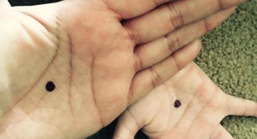 Pet milijuna ljudi priča o ovoj crnoj točki na dlanu!