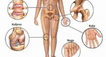 Bolesti zglobova, artroze , Hrskavica , deformacije zgloba