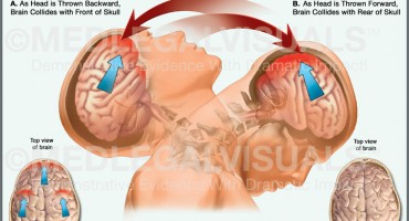 Prometne nesreće i trzajne ozljede vrata