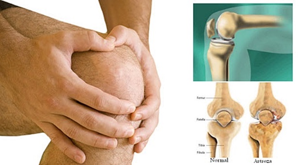 liječenje artroze koljena s hijaluronskom kiselinom)