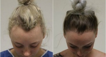 Zbog frizure koju je nosila svaki dan ostala bez kose