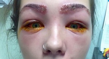Djevojka skoro oslijepila od šminke: Svoje iskustvo i fotografije podijelila na Facebooku