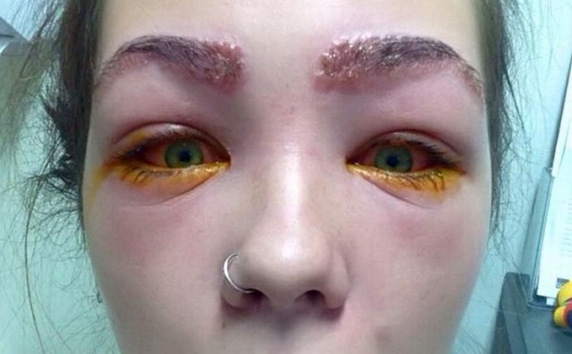 Djevojka skoro oslijepila od šminke: Svoje iskustvo i fotografije podijelila na Facebooku
