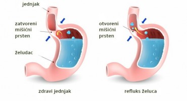 refluks, Simptomi želučanog refluksa, Jednjak