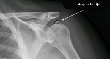 ramena, kalcifikat u ramenu