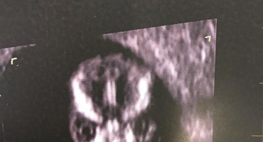 Slika s ultrazvuka iznenadila buduću majku: Ovo je najstrašnije što sam ikad vidjela