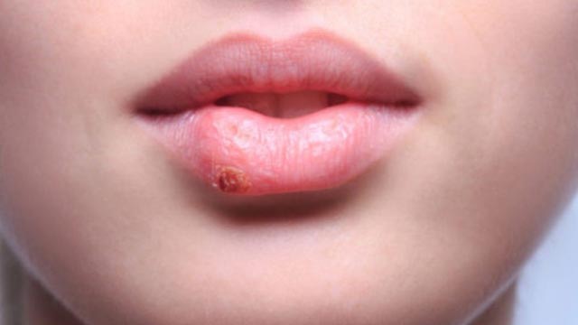 Domaći lijek za herpes na usnama