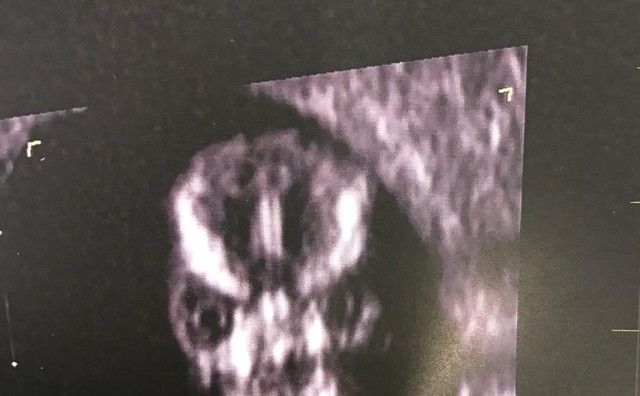 Slika s ultrazvuka iznenadila buduću majku: Ovo je najstrašnije što sam ikad vidjela