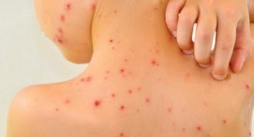 Preminuo dvogodišnji dječak zaražen malim boginjama