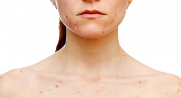 Potvrđena 13. žrtva ospica, nakon dugotrajne borbe preminula dvogodišnja djevojčica