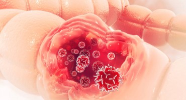 5 simptoma raka debelog crijeva koje ne smijete ignorirati i ako ste mladi