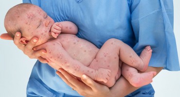 Sad je i službeno potvrđeno: ospice su stigle u Hrvatsku, liječnici apeliraju na roditelje da cijepe djecu