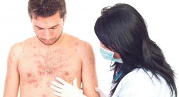 Zbog majmunskih boginja Srbija nadzire granicu, troje umrlo od Zapadnog Nila u BiH