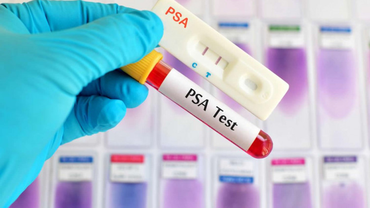 PSA test
