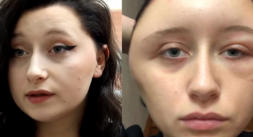  Oprezno s farbom: ženi cijela glava nabubrila zbog jake alergijske reakcije 