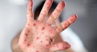 U Sarajevu 350 oboljelih, dvoje djece kritično