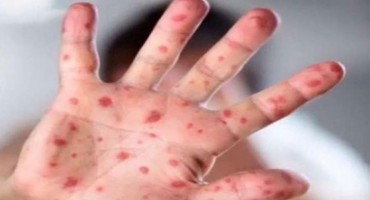 Epidemija ospica u Sarajevu: Dvije bebe u teškom stanju