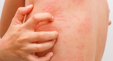 Od šuge u FBiH oboljele 103 osobe, od čega ih je u HNŽ-u 26