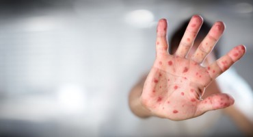 Ponovno izbijanje vrlo zarazne bolesti: Najveći broj slučajeva ospica u SAD-u još od 2000. godine