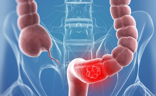 Pet simptoma raka debelog crijeva koji često promaknu